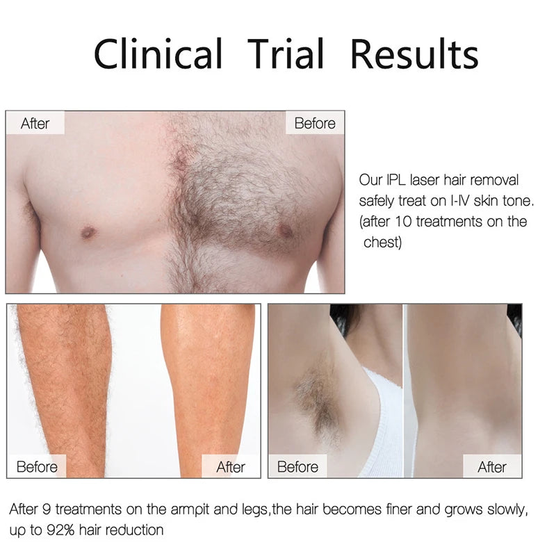 Mini IPL Laser Epilator – Painless Hair Removal at Home