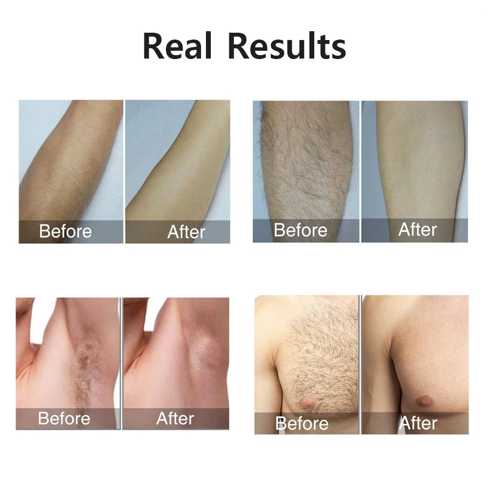 Mini IPL Laser Epilator – Painless Hair Removal at Home